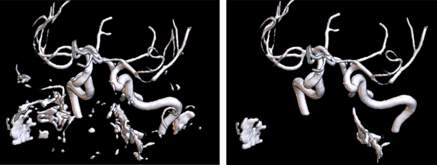 Patch-Wise Deep Learning Method for Intracranial Stenosis and Aneurysm Detection-the Tromsø Study