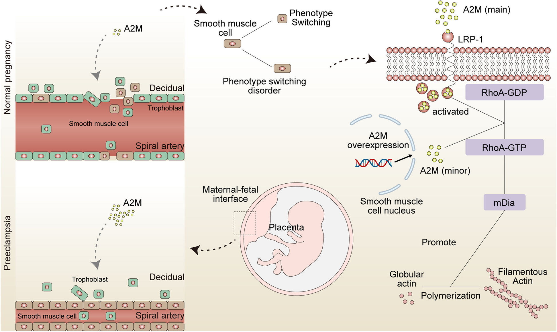 Targeting A2M-LRP1 reverses uterine spiral artery remodeling disorder and alleviates the progression of preeclampsia