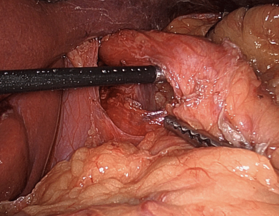 Flap Valve-Preserving Vertical Sleeve Gastrectomy (INNOVATE-VSG): Clinical Trial Study Protocol