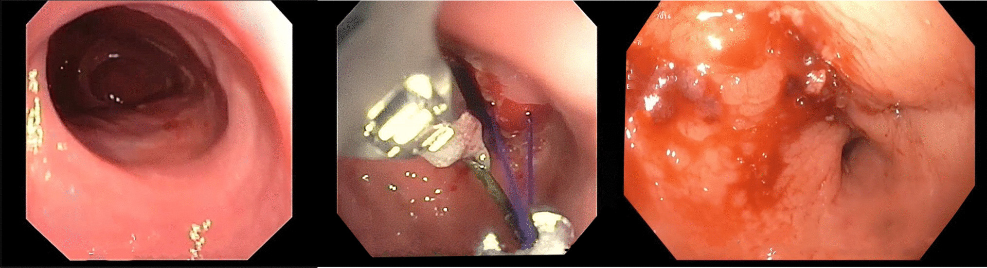 Indications and Outcomes of Endoscopic Gastric Pouch Plications After Bariatric Surgery: An Analysis of the Metabolic and Bariatric Surgery Accreditation and Quality Improvement Program (MBSAQIP) Database