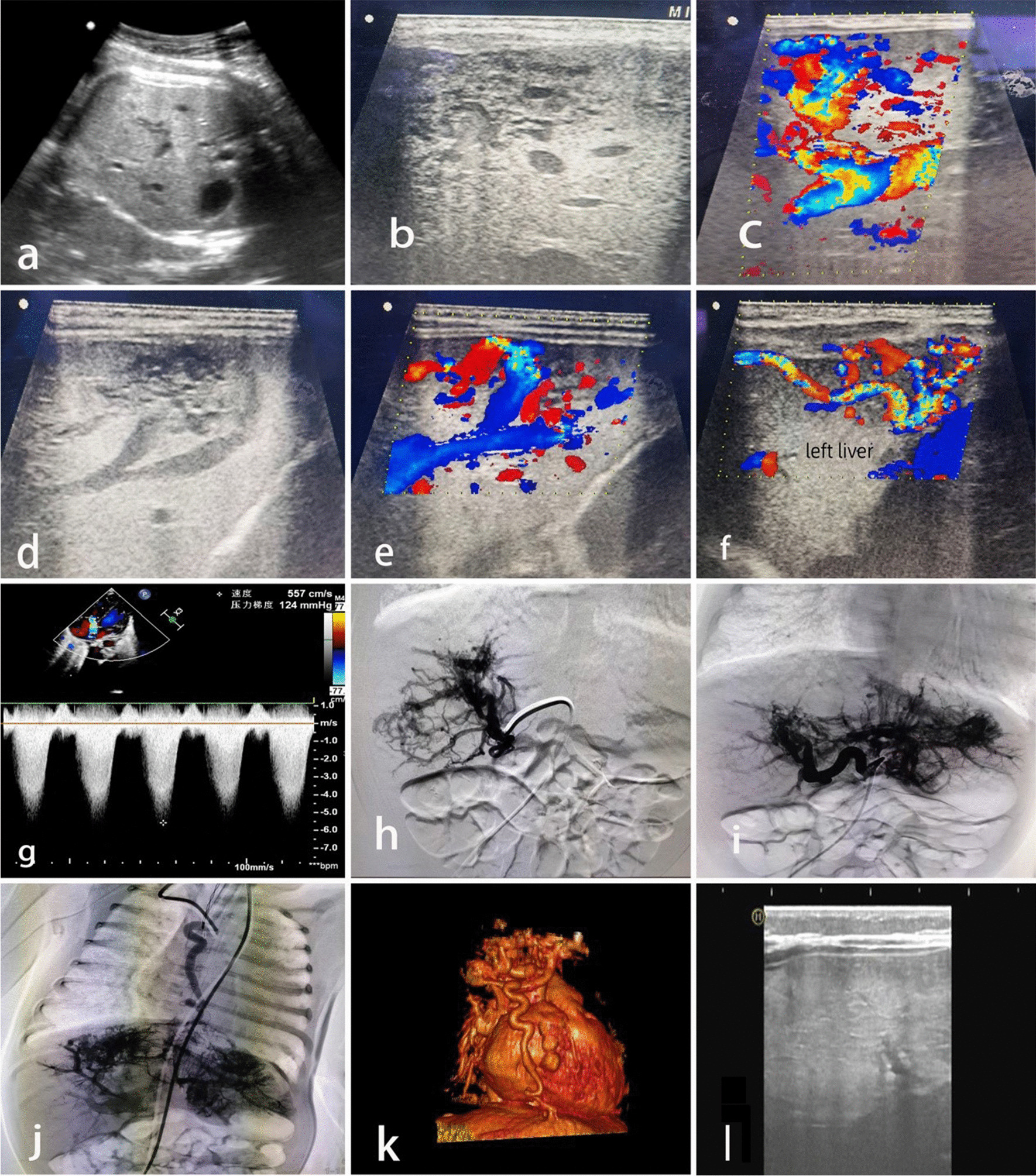 Ultrasonographic diagnosis and follow-up of a special type of giant fetal hepatic hemangioma