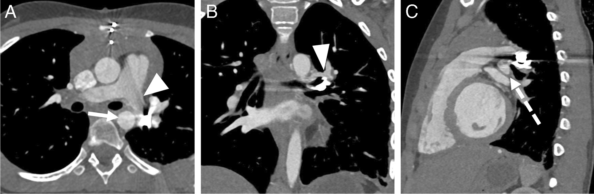 Use of photon-counting CT and three-dimensional printing for an intra-thoracic retained ballistic fragment in a 9-year-old