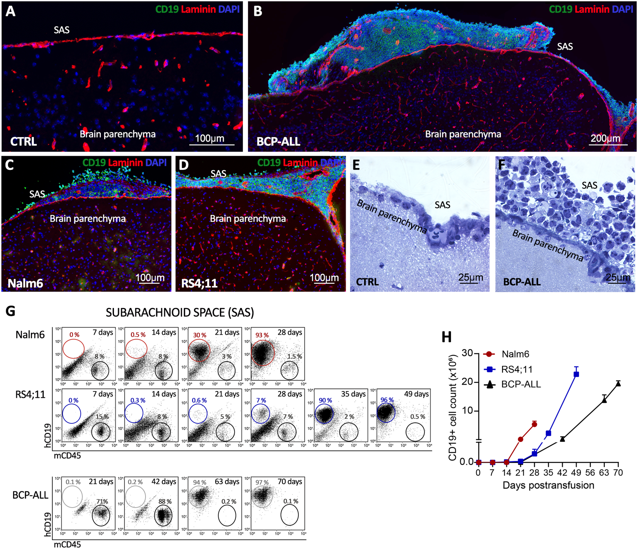 Meningeal leukaemic aggregates as foci of cell expansion and chemoresistance in acute lymphoblastic leukaemia metastasis