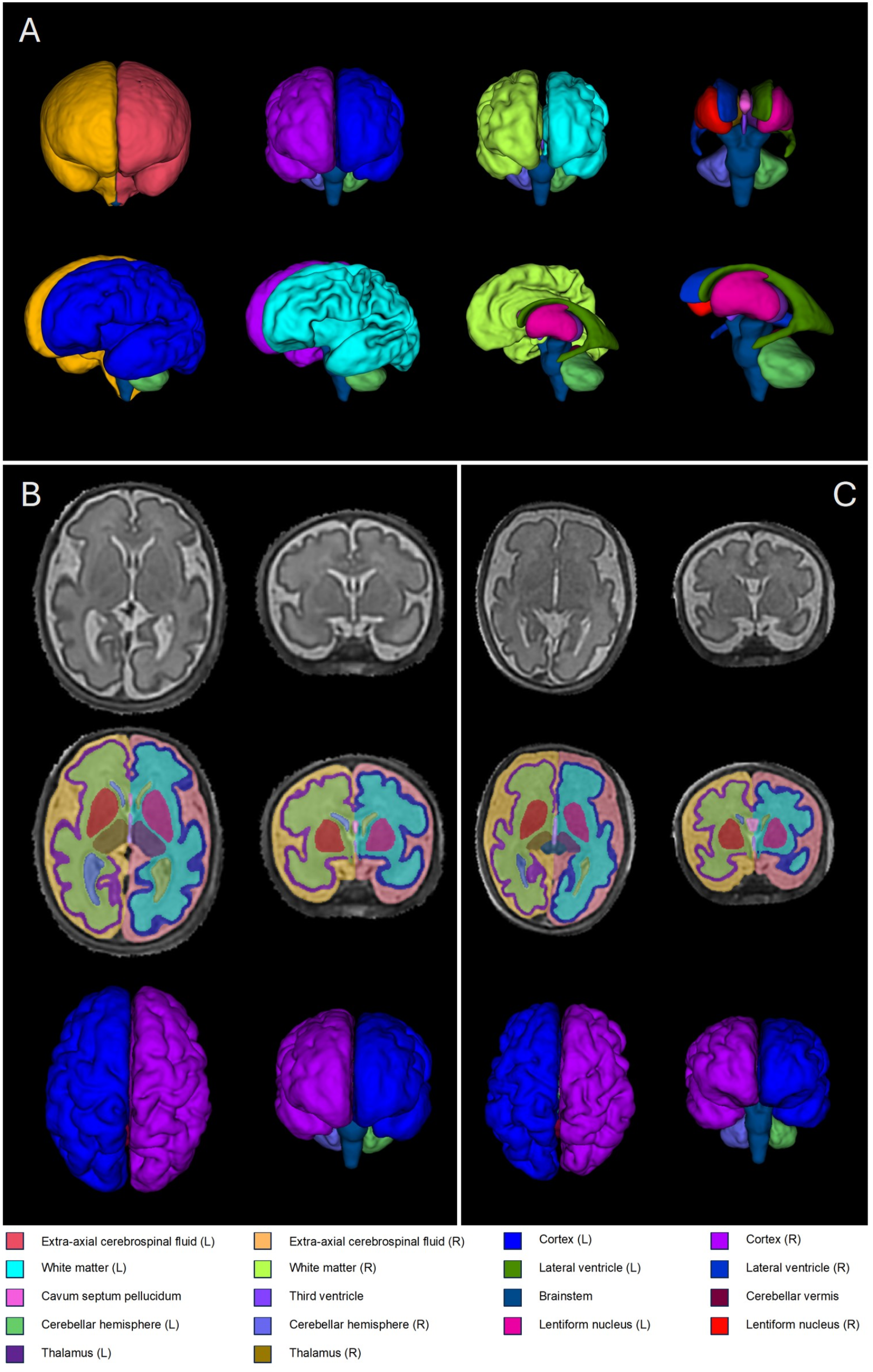 An exploratory fetal MRI study examining the impact of 22q11.2 microdeletion syndrome on early brain growth