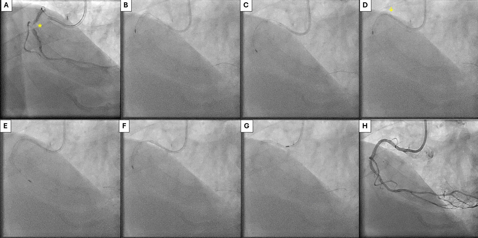 Simple bailout method for burr entrapment in rotational atherectomy
