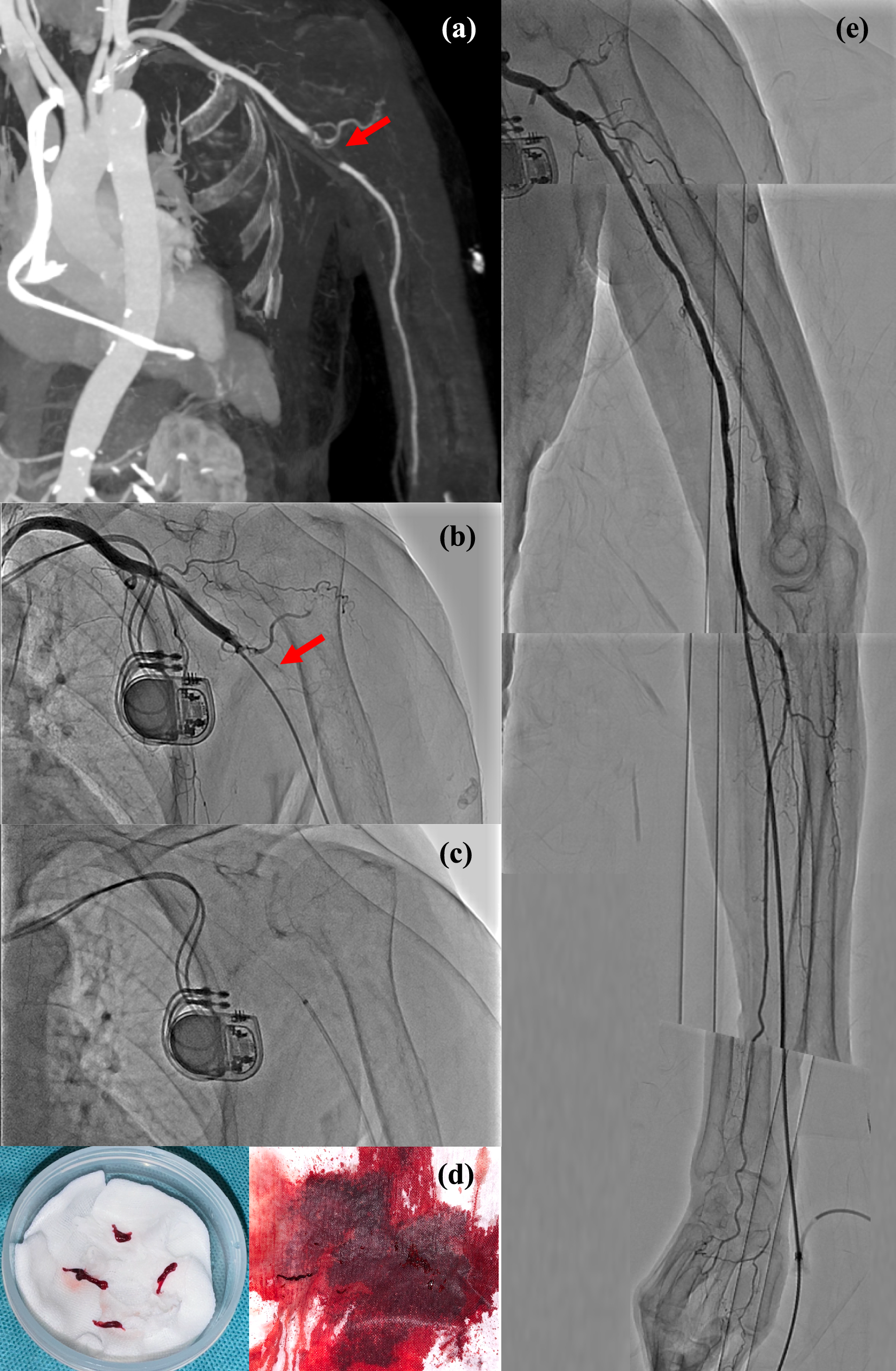 Successful percutaneous catheter thrombectomy for acute axillary artery occlusion