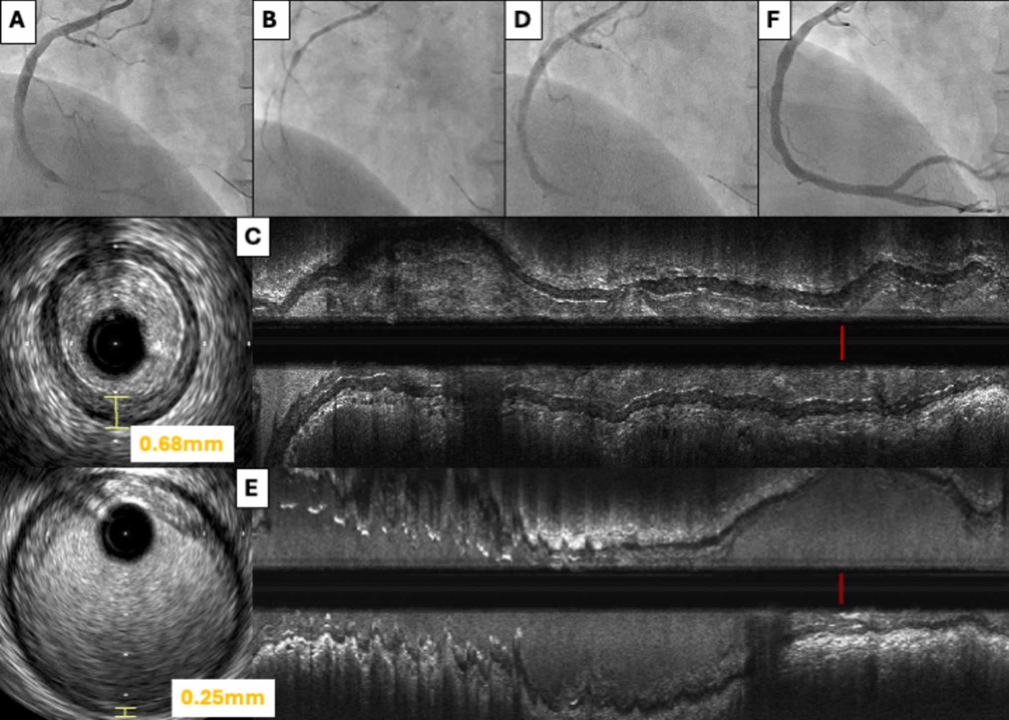 Intravascular ultrasound can distinguish between thrombus formation and coronary vasospasm during primary percutaneous coronary intervention