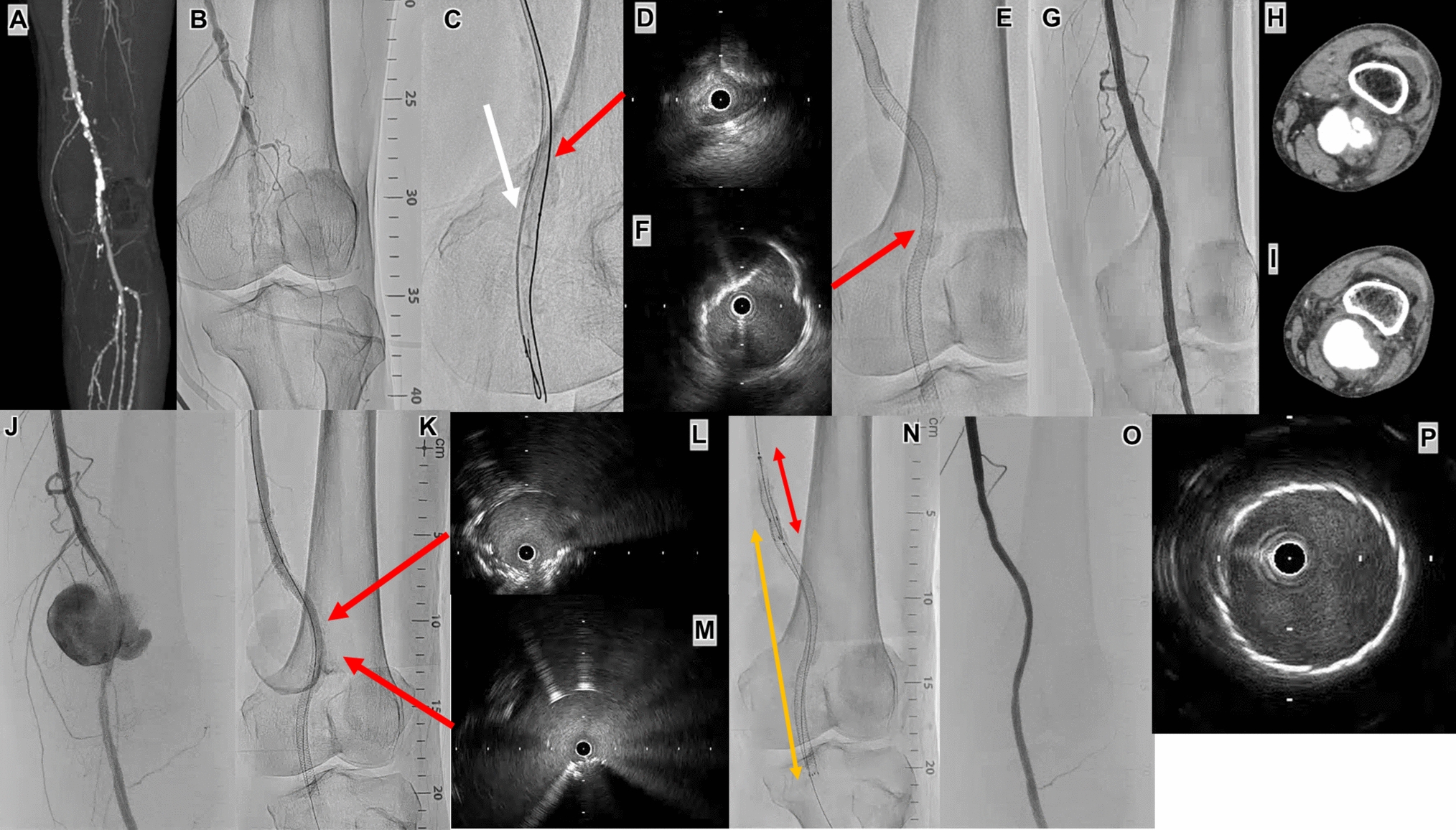 Huge pseudoaneurysm in severe calcified popliteal artery occlusion early after Supera stent implantation
