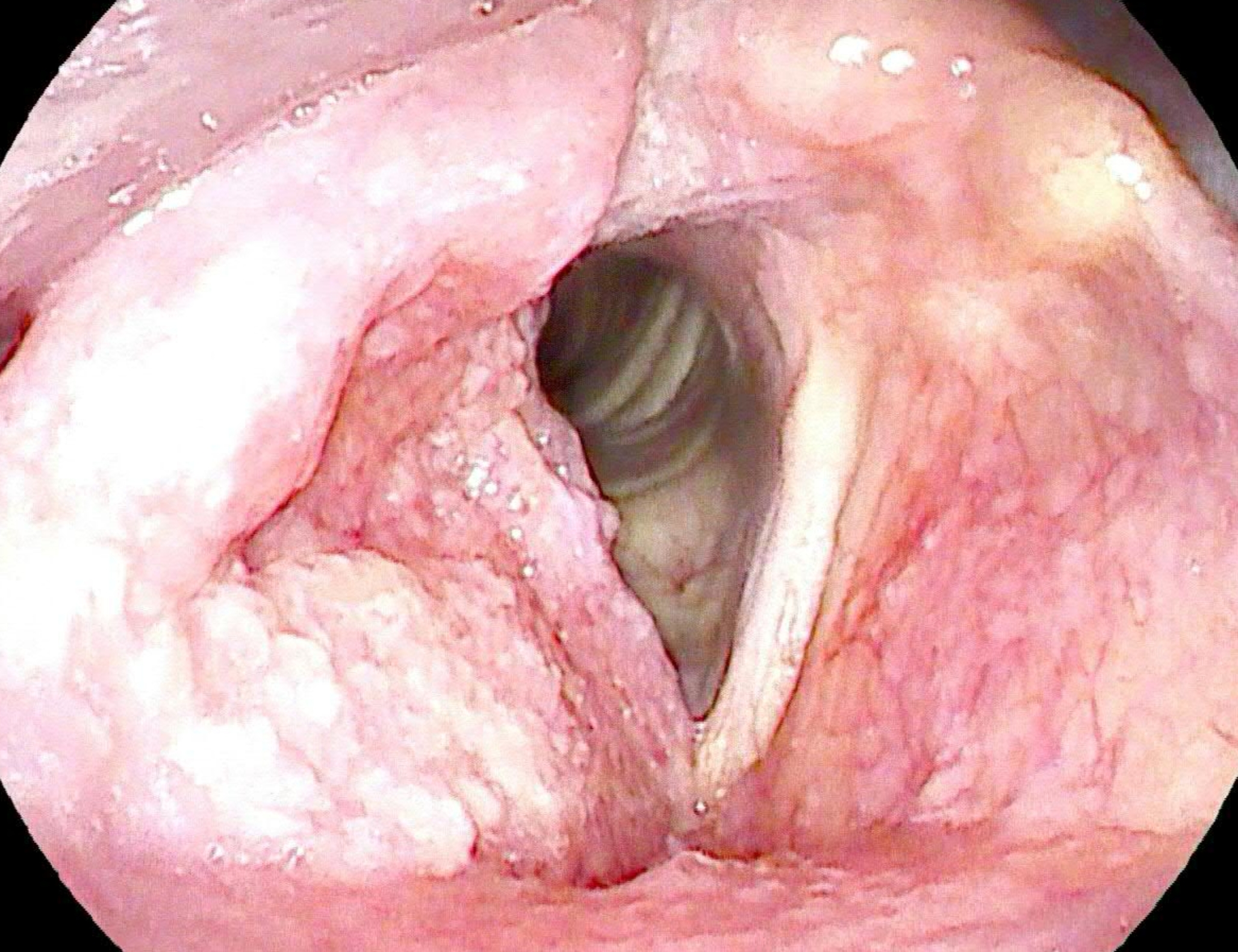 Laryngeal Coccidioidomycosis Mimicking Squamous Cell Carcinoma