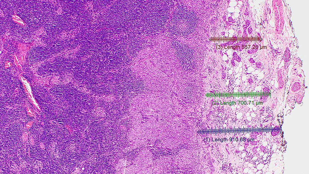 International Consensus Recommendations of Diagnostic Criteria and Terminologies for Extranodal Extension in Head and Neck Squamous Cell Carcinoma: An HN CLEAR Initiative ()