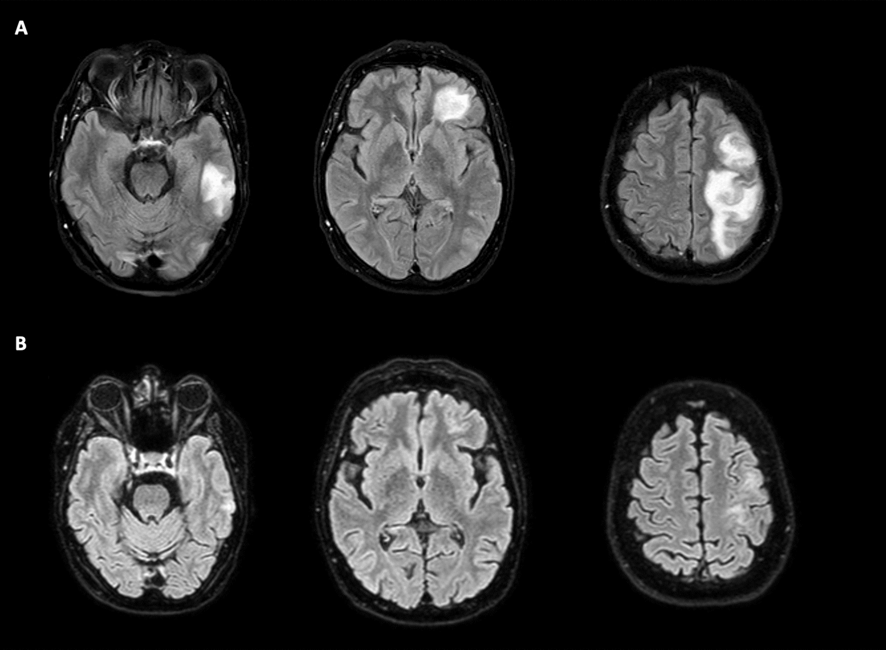 Cerebral foreign body reaction (CFBR) after endovascular treatments is a rare event to be aware of: case series and review of literature
