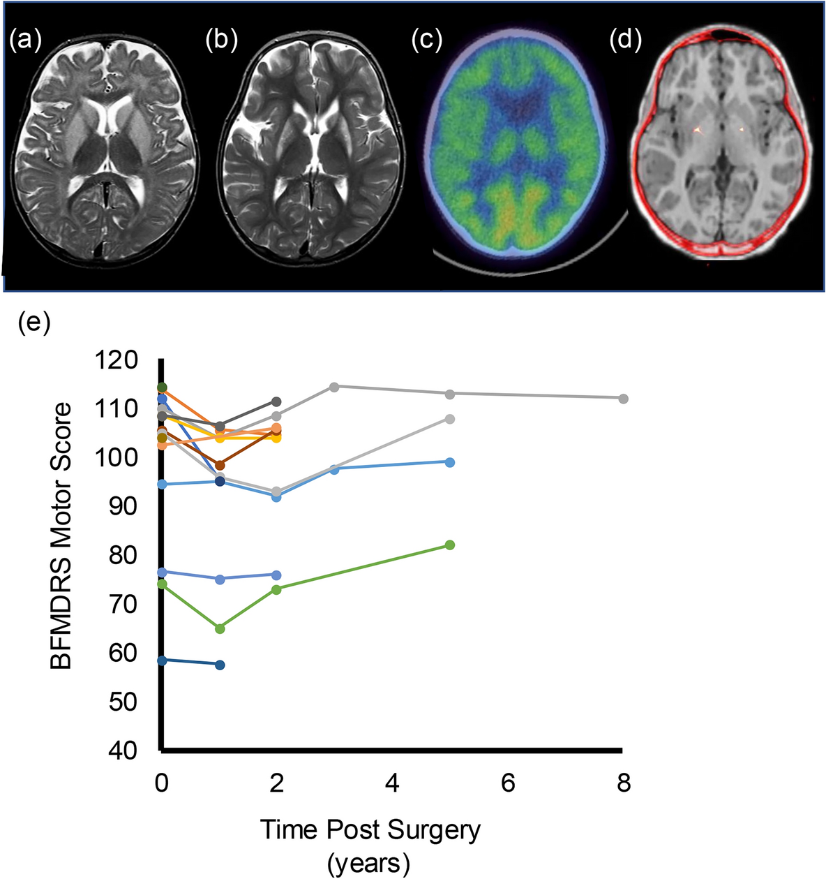 Outcomes of deep brain stimulation surgery in the management of dystonia in glutaric aciduria type 1