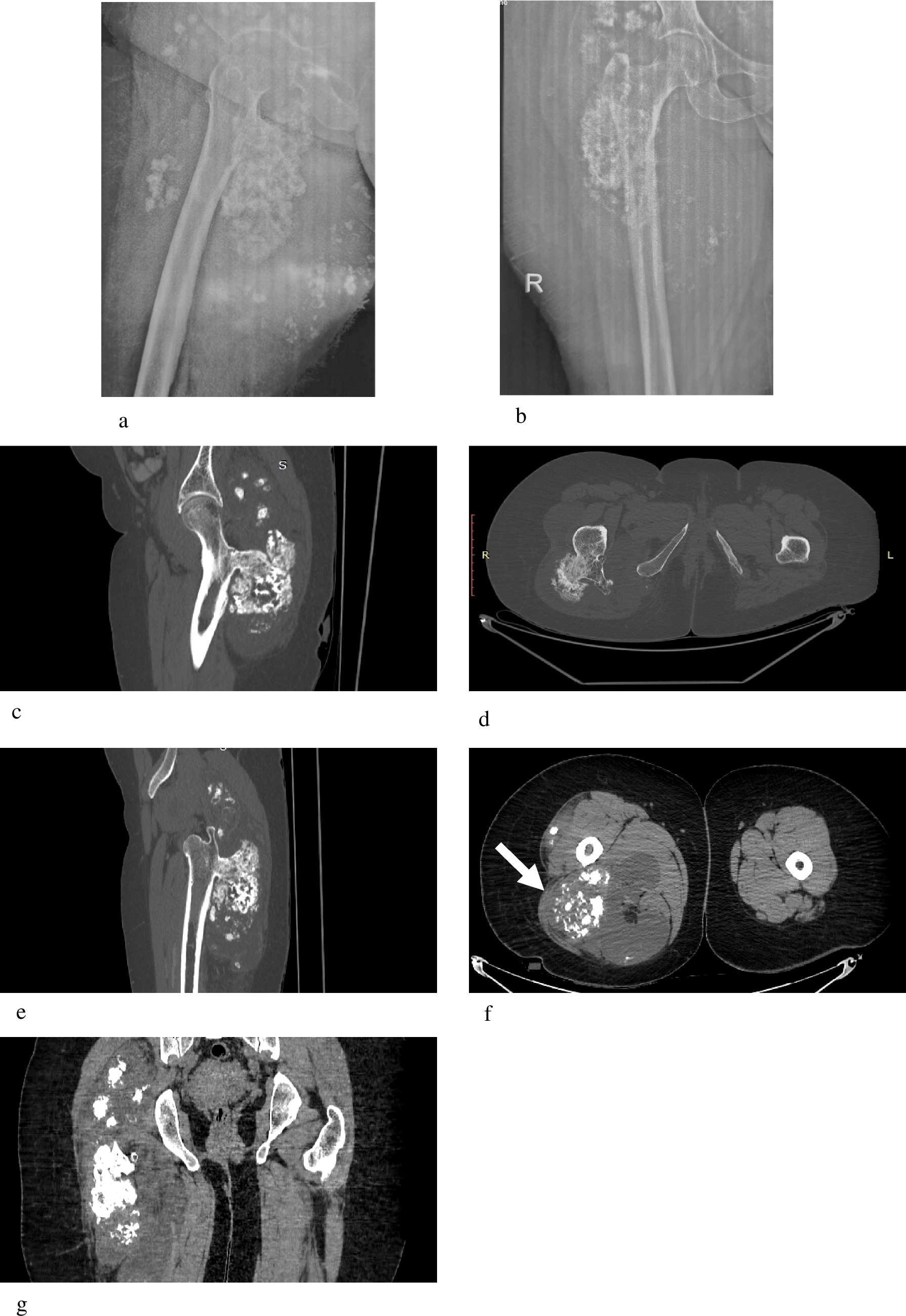 Malignant transformation of osteochondroma to chondrosarcoma: a challenging case