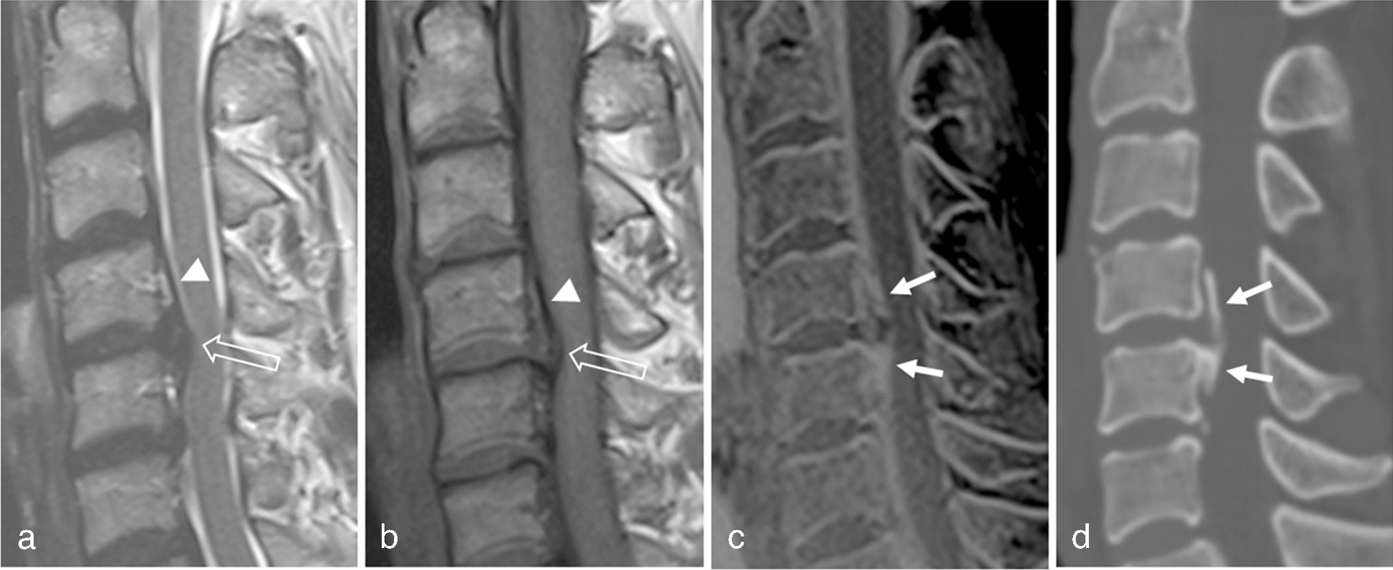 CT-like image based on 3D fast low-angle shot: superior diagnostic performance of ossification of the posterior longitudinal ligament