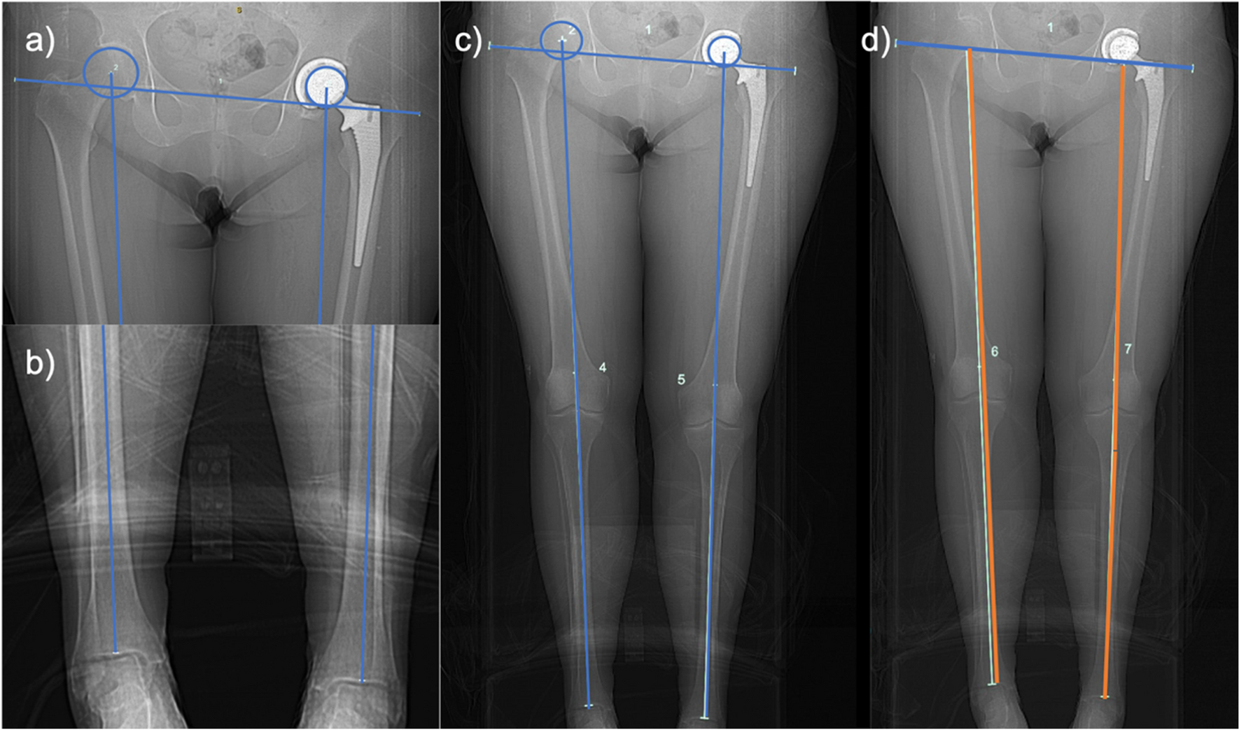 Scanogram leg length measurement after total hip arthroplasty: not all landmarks are created equal