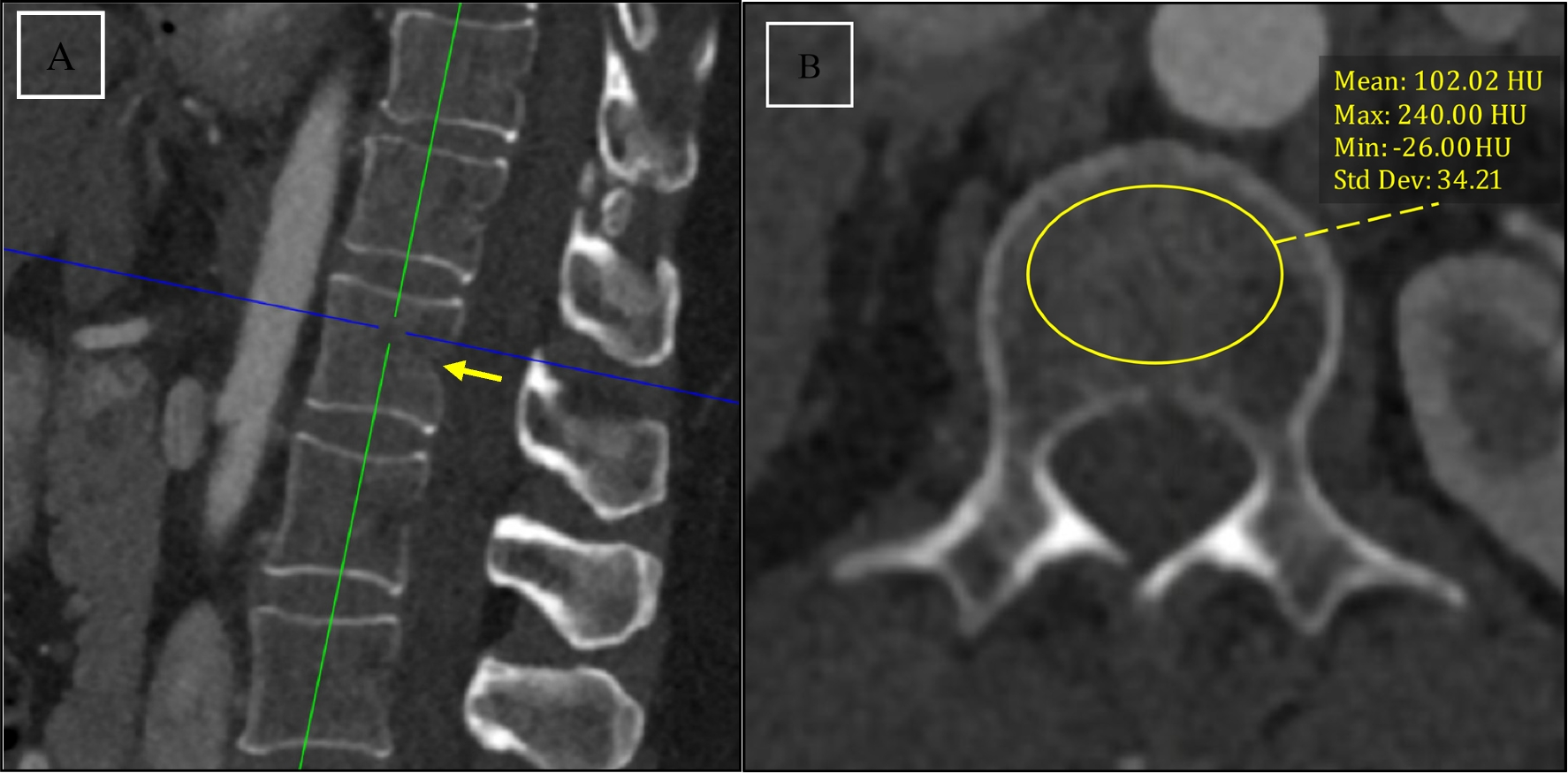Opportunistic screening for osteoporosis: validation study for L1 bone density measurements using contrast-enhanced chest and abdominal CTs