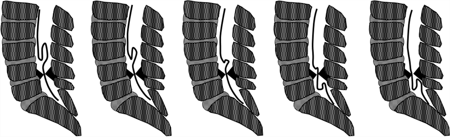 Cauda equina movements during the Valsalva maneuver in patients with lumbar spinal stenosis: introducing a novel method for redundant nerve evaluations
