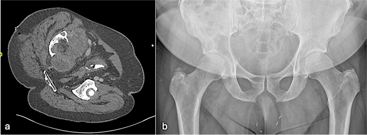 Test Yourself Question: An elderly man presenting with features of cauda equina