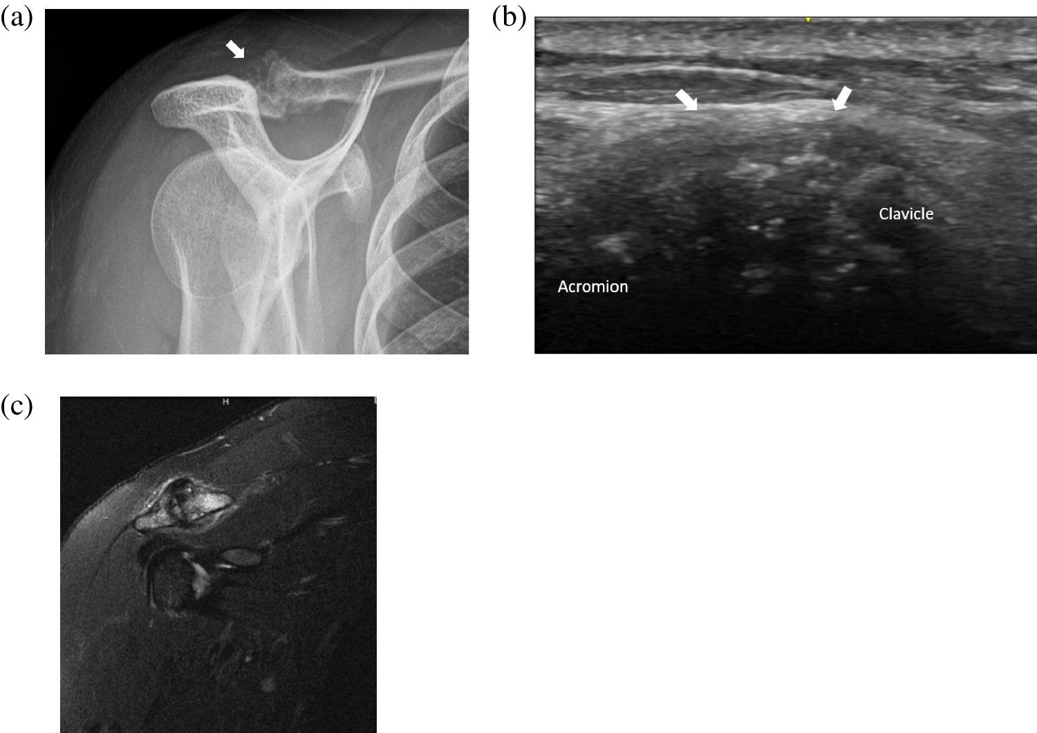 Ultrasonography in the assessment of calcium pyrophosphate deposition disease