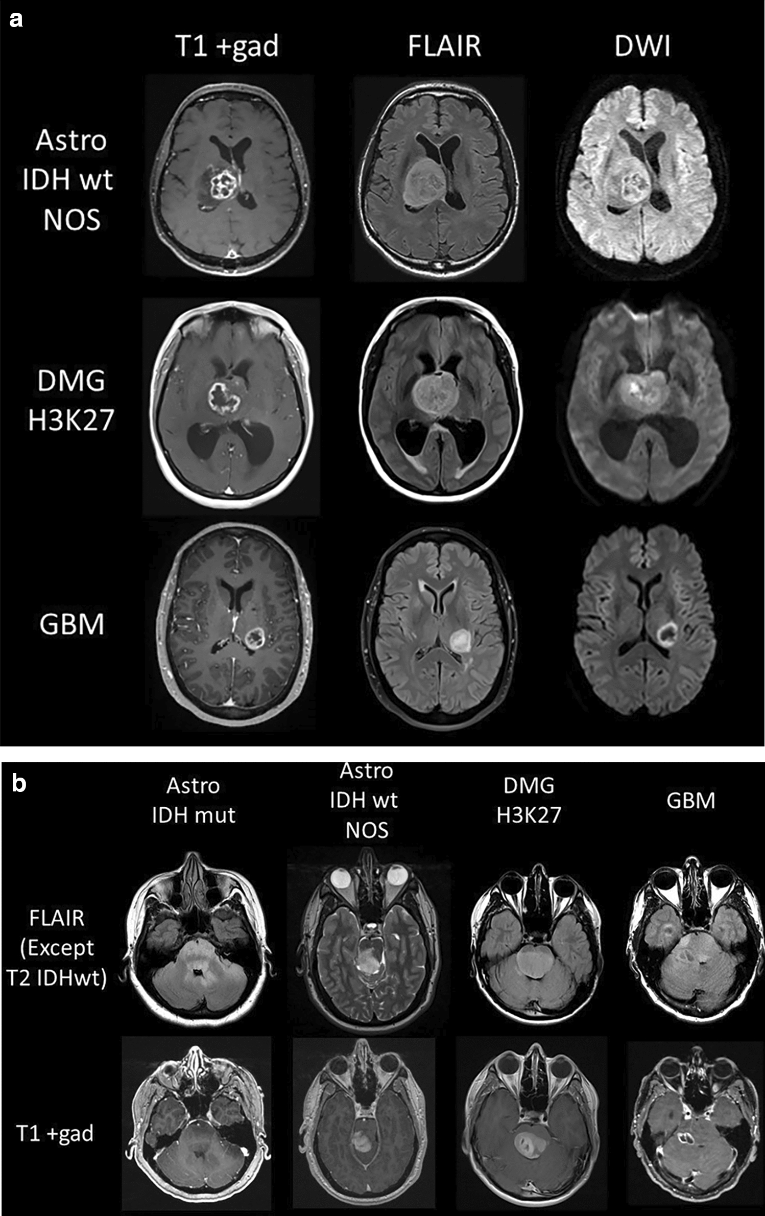 Characterizing the molecular and spatial heterogeneity of midline gliomas in adults: a single institution analysis