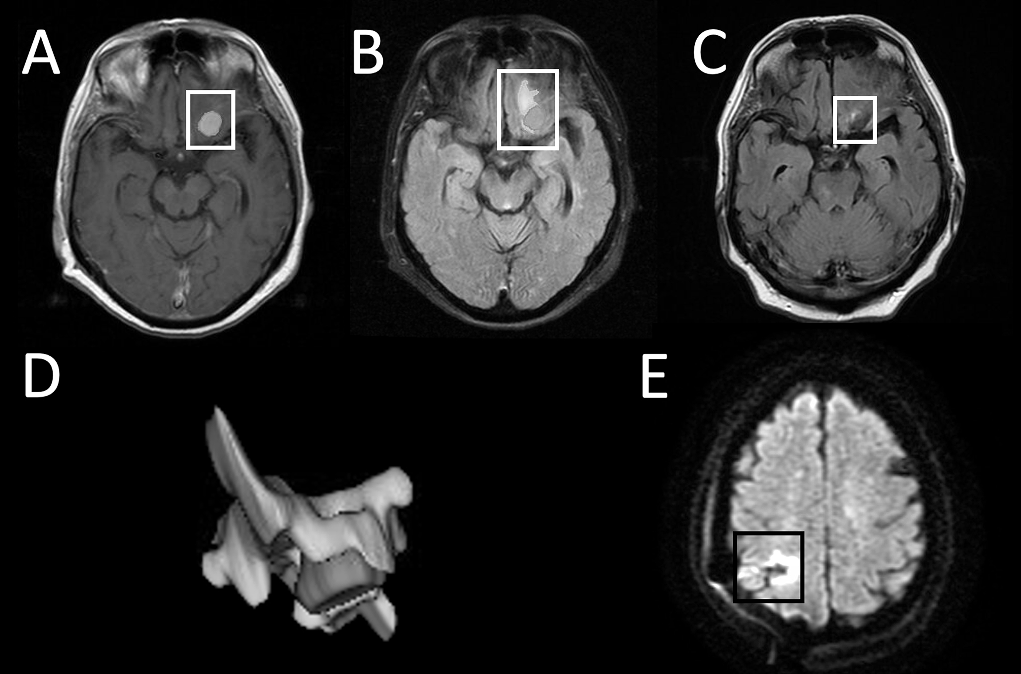 Peritumoral edema resolves infrequently in surgically treated patients with intracranial meningioma– a retrospective study of 279 meningioma patients