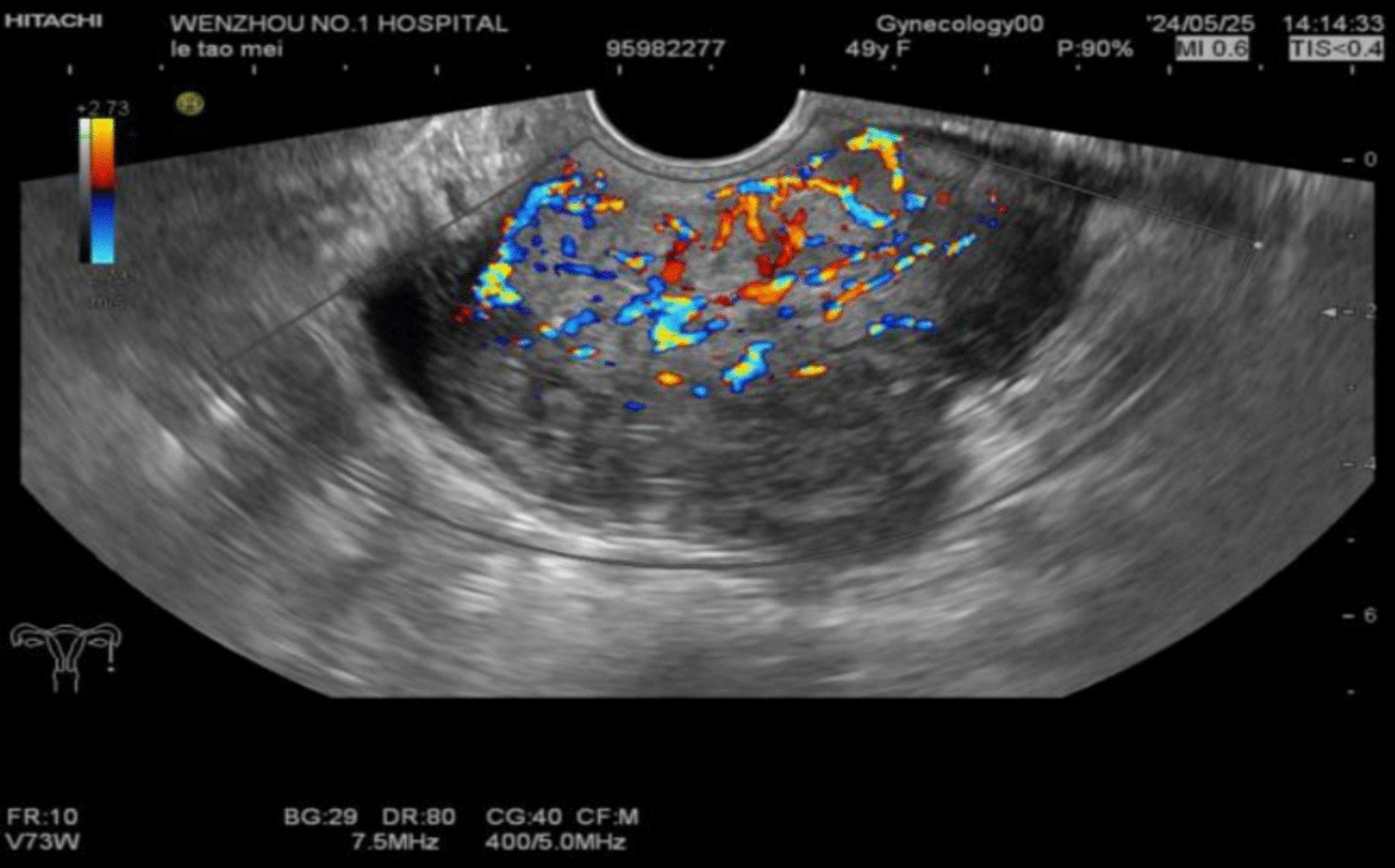 A Primary Low-Grade Vaginal Extrauterine Endometrial Stromal Sarcoma: A Case Report