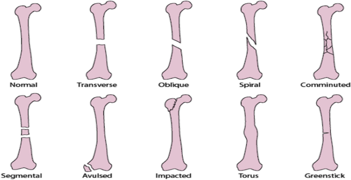 Osteo fracture identification using deep learning techniques