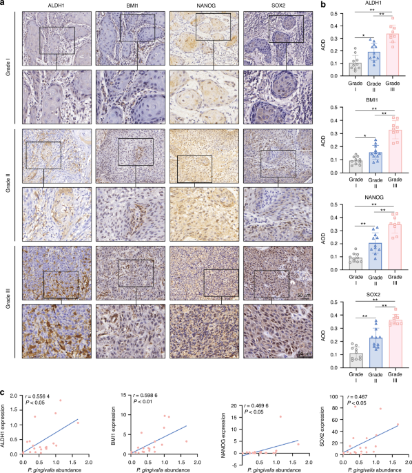 Porphyromonas gingivalis potentiates stem-like properties of oral squamous cell carcinoma by modulating SCD1-dependent lipid synthesis via NOD1/KLF5 axis