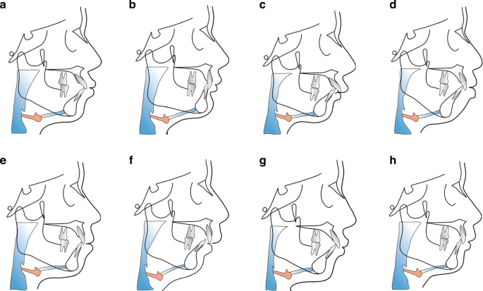 Expert consensus on orthodontic treatment of protrusive facial deformities
