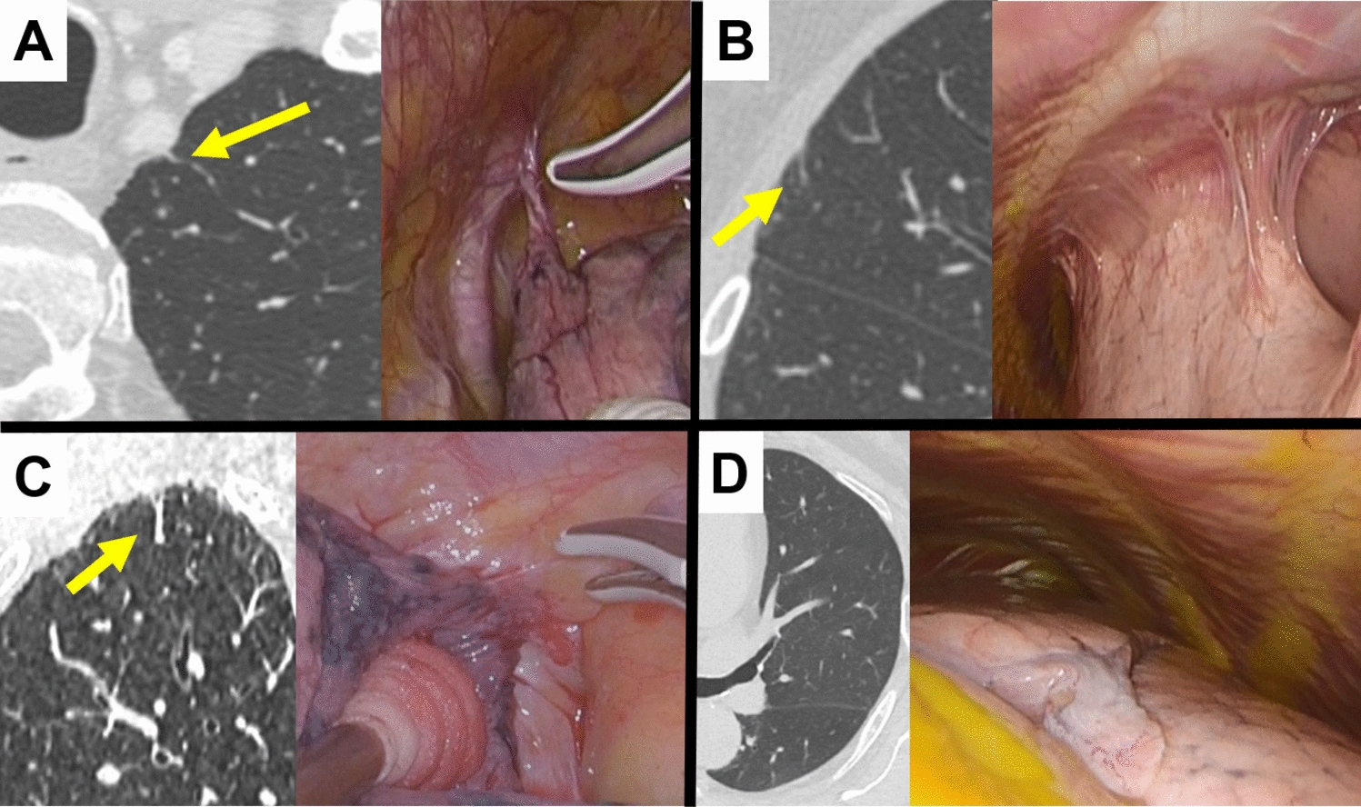An increase in micro-vessels beneath the pleural surface on computed tomography as a preoperative predictor of pleural adhesions: a prospective study