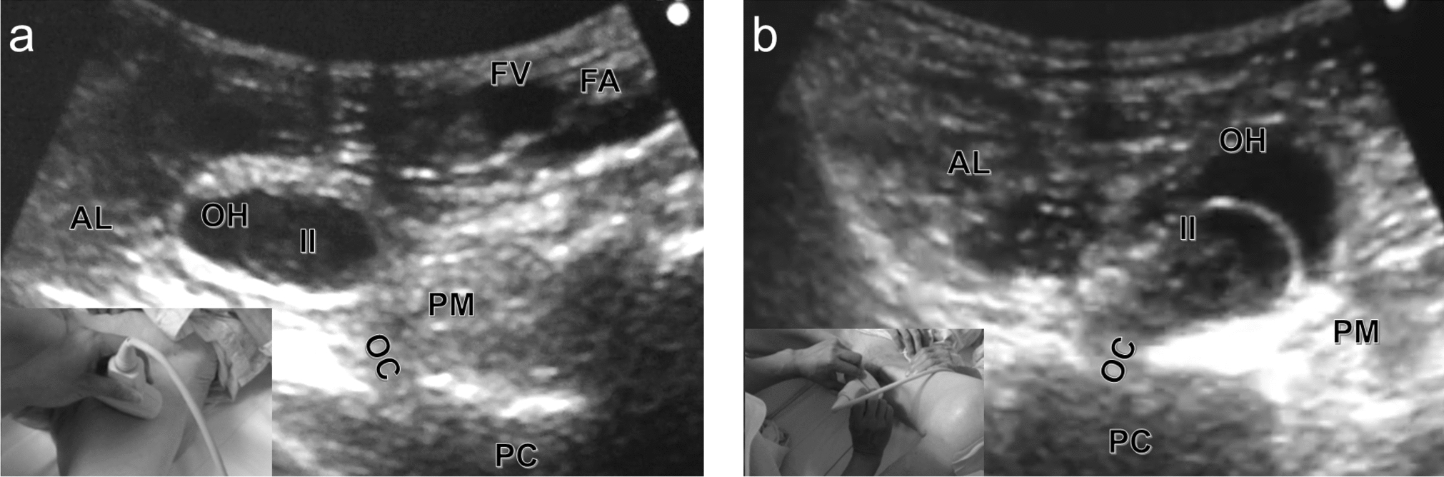 Advantages of ultrasound-guided reduction and elective surgery versus emergency repair for incarcerated obturator hernia