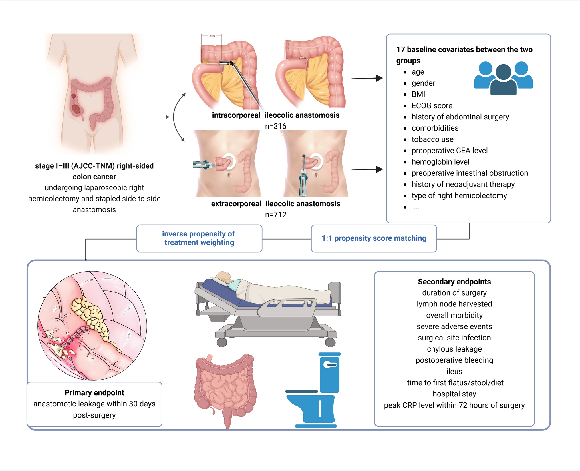 Short-term outcomes of extracorporeal versus intracorporeal side-to-side anastomosis after laparoscopic right hemicolectomy for colon cancer: an affiliated study of a multicenter snapshot study