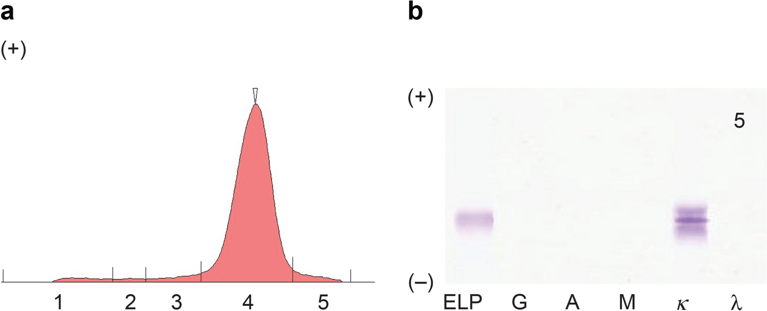 A case of renal infiltration by Bence Jones protein kappa-producing lymphoplasmacytic lymphoma