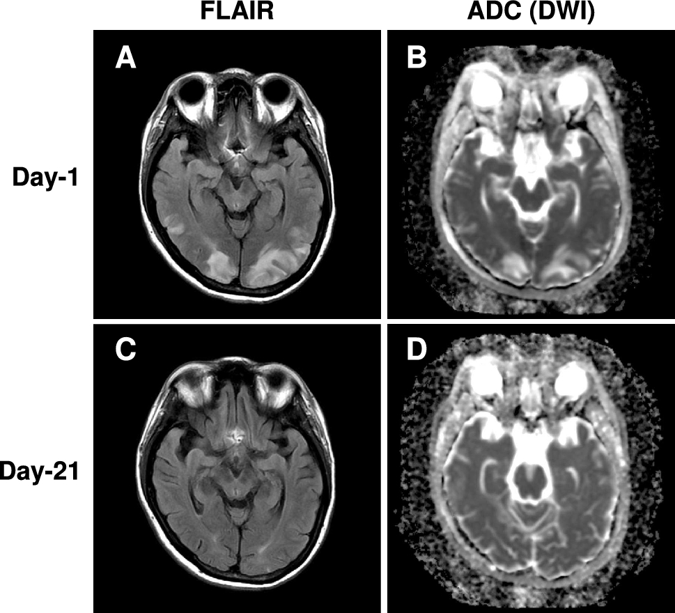 A case of posterior and reversible encephalopathy syndrome in a patient previously undiagnosed with lupus nephritis
