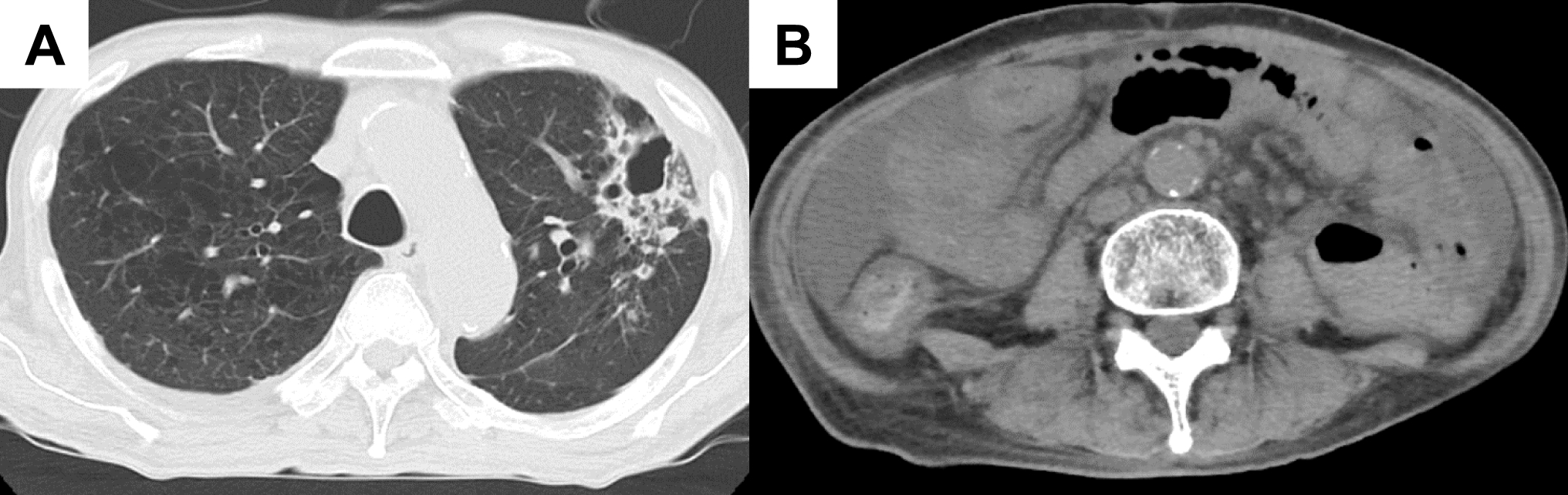 IgA vasculitis with nephritis accompanied by pulmonary tuberculosis: a case report