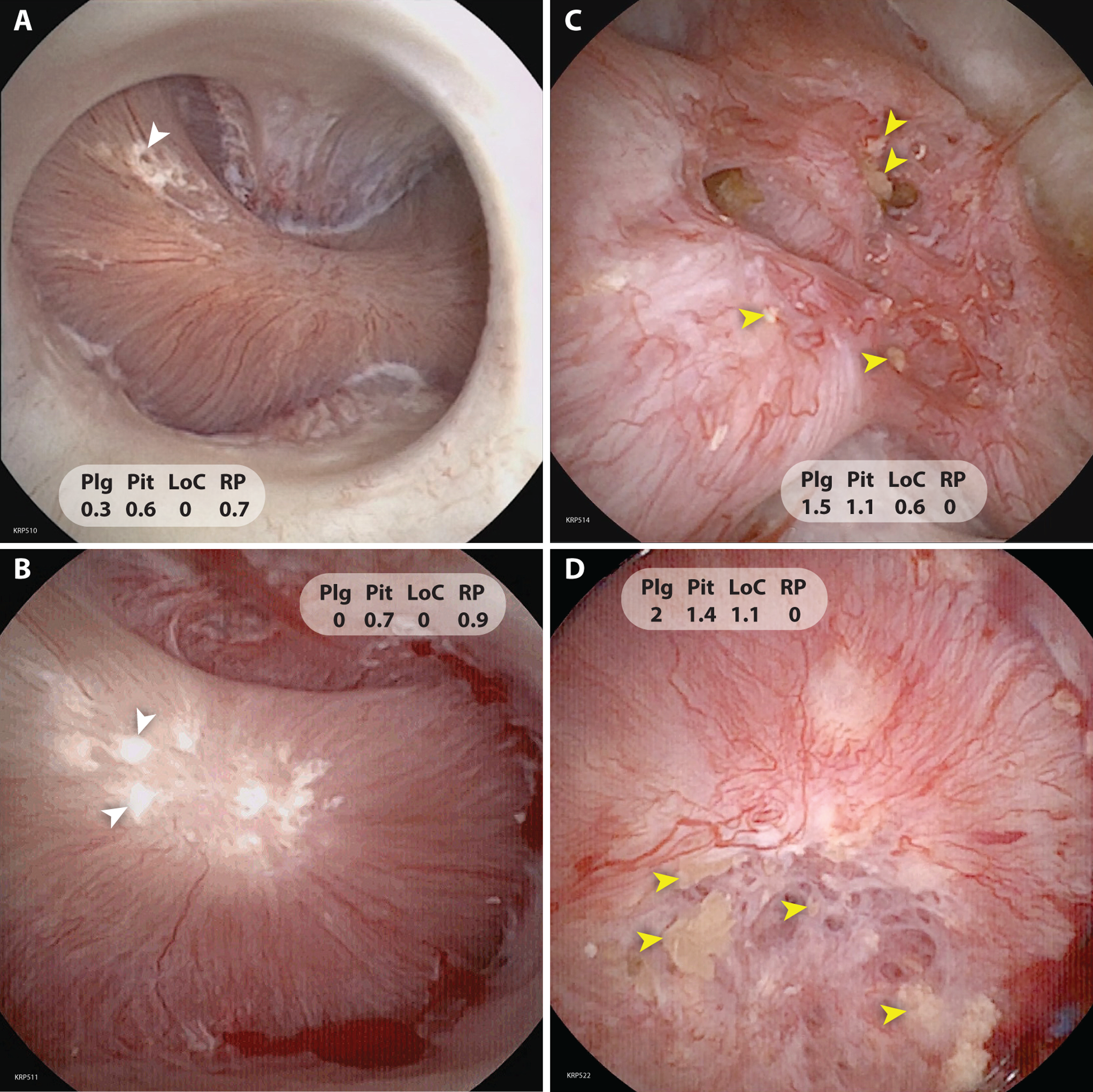 Recent developments in the study of cellular inflammation in the papillae of stone formers