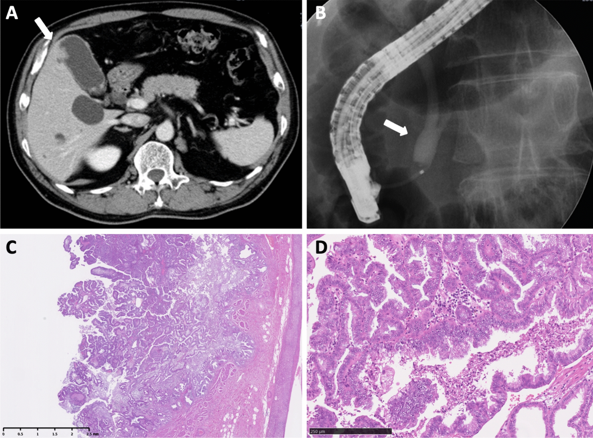 Pancreatic cancer secondary to biliary tract cancer associated with pancreaticobiliary maljunction: intraductal dissemination through the common channel