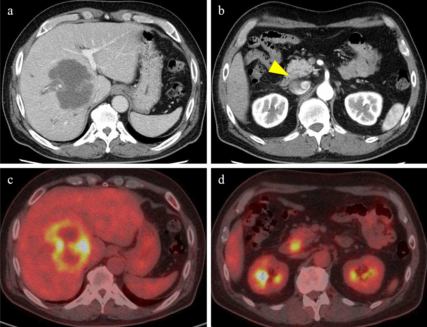 Microsatellite-high intrahepatic cholangiocarcinoma with favorable treatment outcome using pembrolizumab