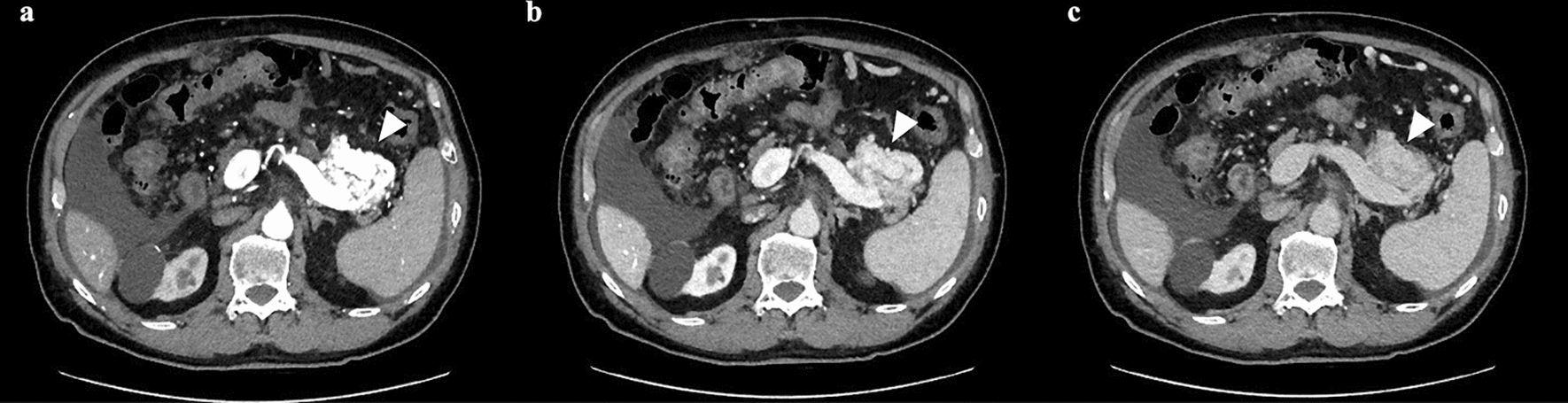 A case of pancreatic arteriovenous malformation diagnosed after the onset of abdominal symptoms