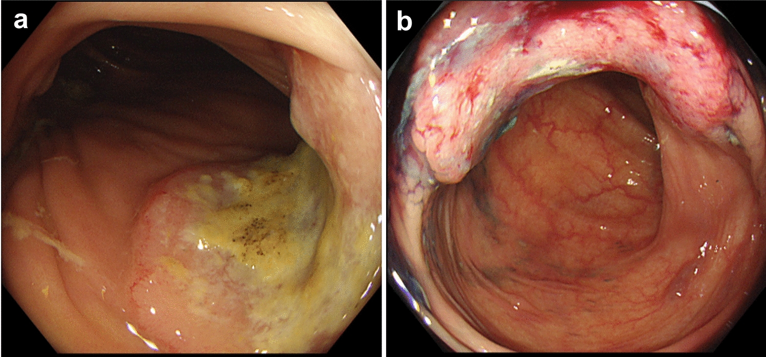 A case of multiple advanced colon cancers with spontaneous regression of only one lesion after biopsy a case report and literature review