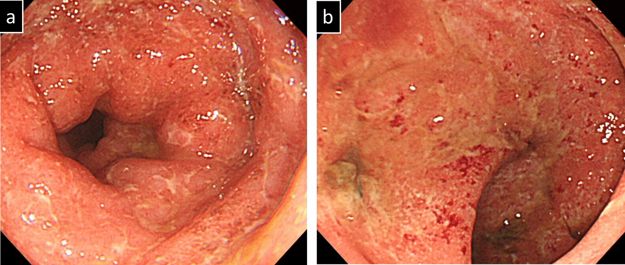 A case of relapsed pan-colonic ulcerative colitis accompanied with gastroduodenal lesions immediately after COVID-19