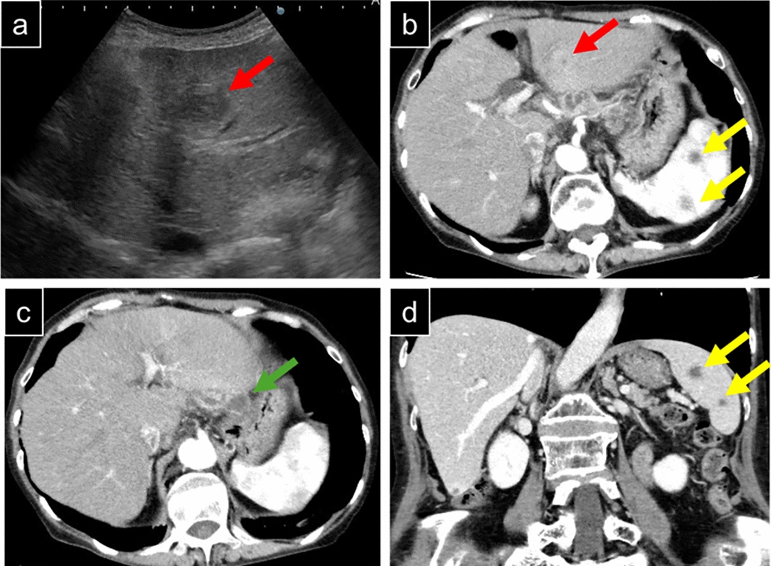 A case of chronic hepatitis B complicated by systemic sarcoidosis that regressed following nucleos(t)ide analog therapy