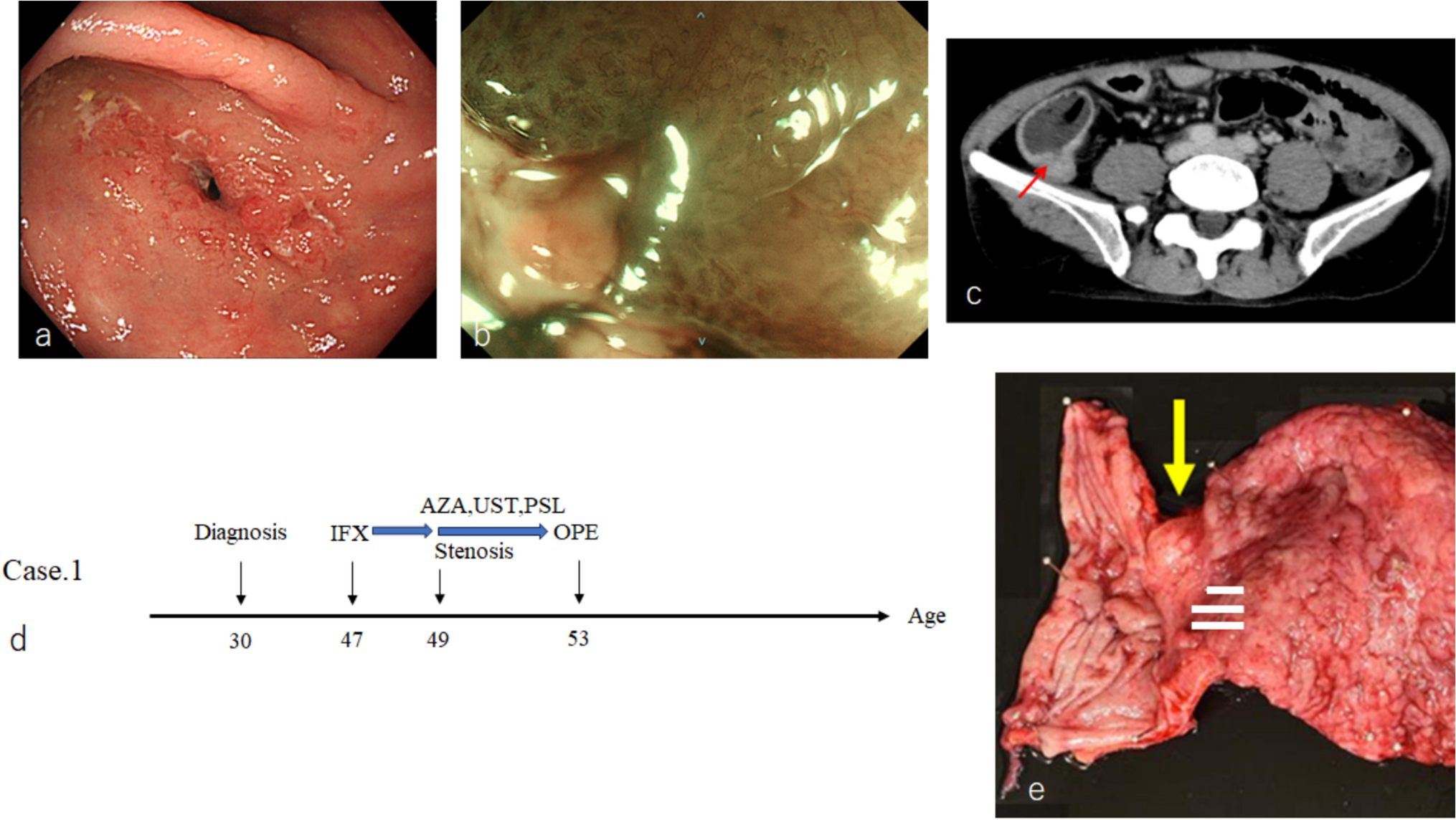 Case series of small bowel adenocarcinoma associated with Crohn’s disease