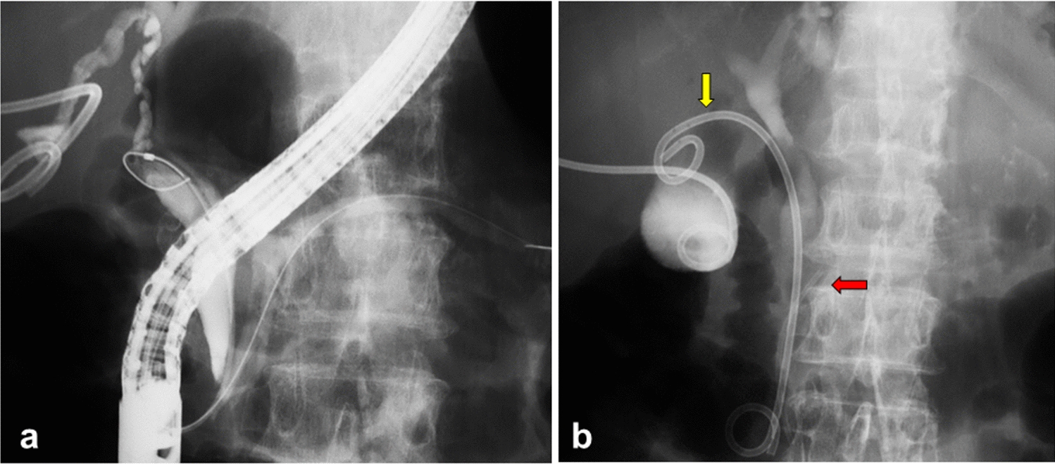 Ascending colon perforation by a migrated pancreatic spontaneous dislodgment stent: a case report