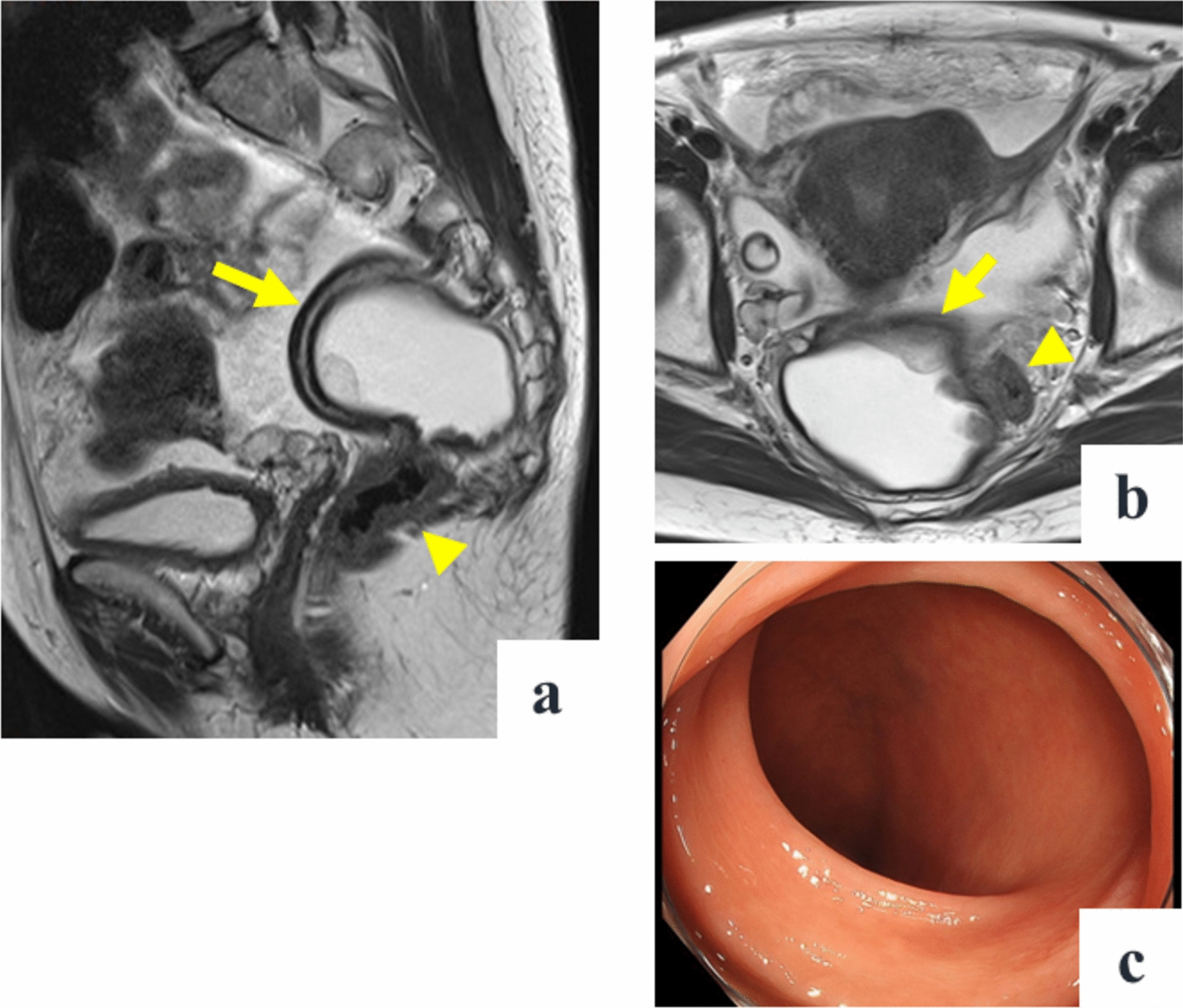 A case of deep endometriosis with cyst formation as a differential diagnosis of rectal duplication cyst in the presacral space