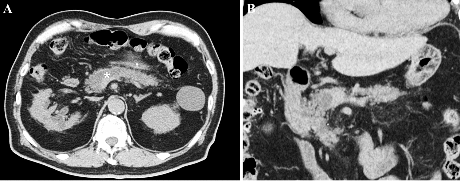 A case of pancreatic ductal adenocarcinoma growing within the pancreatic duct mimicking an intraductal tubulopapillary neoplasm