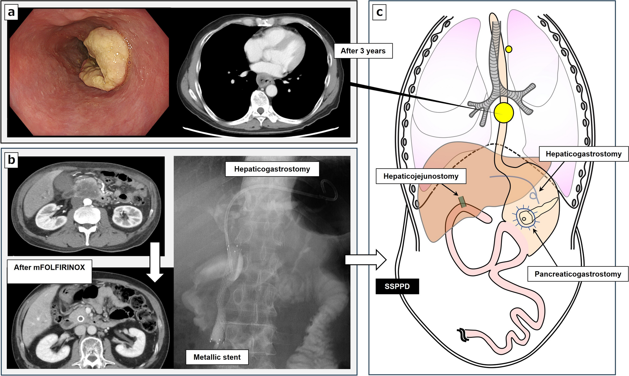 Successful staged surgery for advanced esophageal cancer after conversion pancreatoduodenectomy with pancreaticogastrostomy