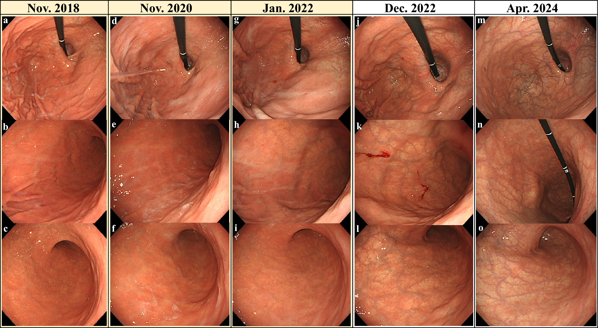 Enhanced activity of autoimmune gastritis following  eradication therapy
