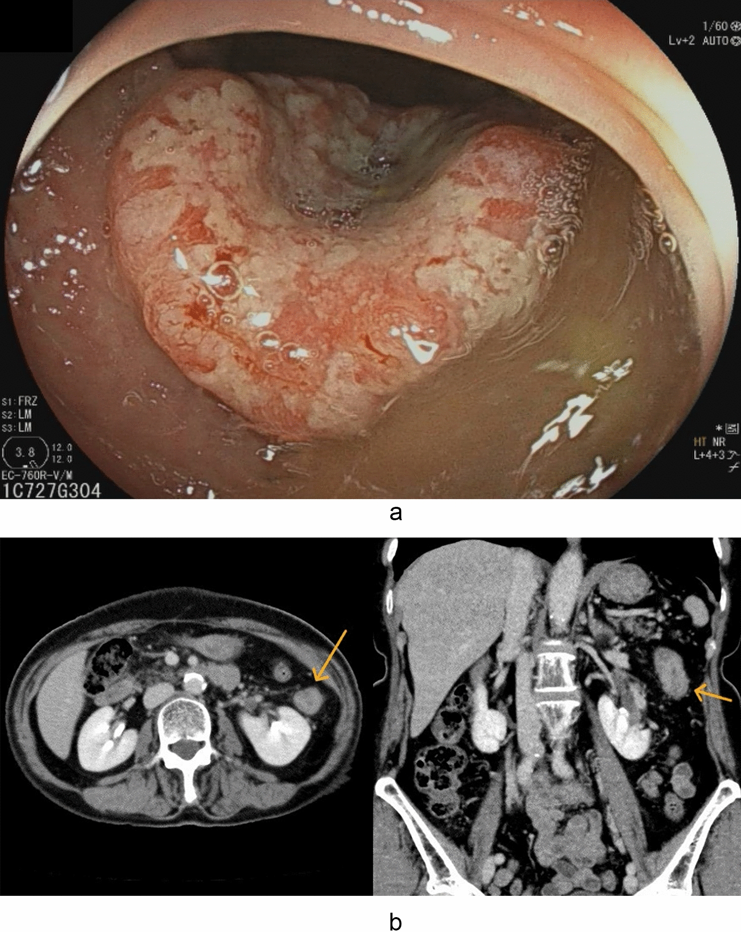 Mixed neuroendocrine-non-neuroendocrine neoplasm of the colon treated with laparoscopic resection and adjuvant chemotherapy: a case report