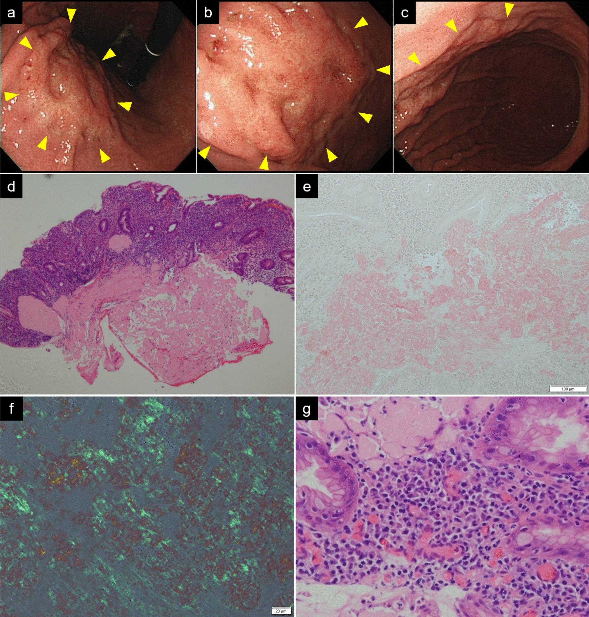 Localized light chain amyloidosis of the stomach that regressed after eradication of  over 15 years of follow-up: a case report and new hypothesis